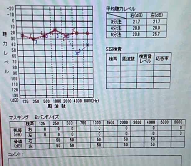 大阪市住吉区長崎はりきゅう接骨院の突発性難聴のオージオグラフの画像