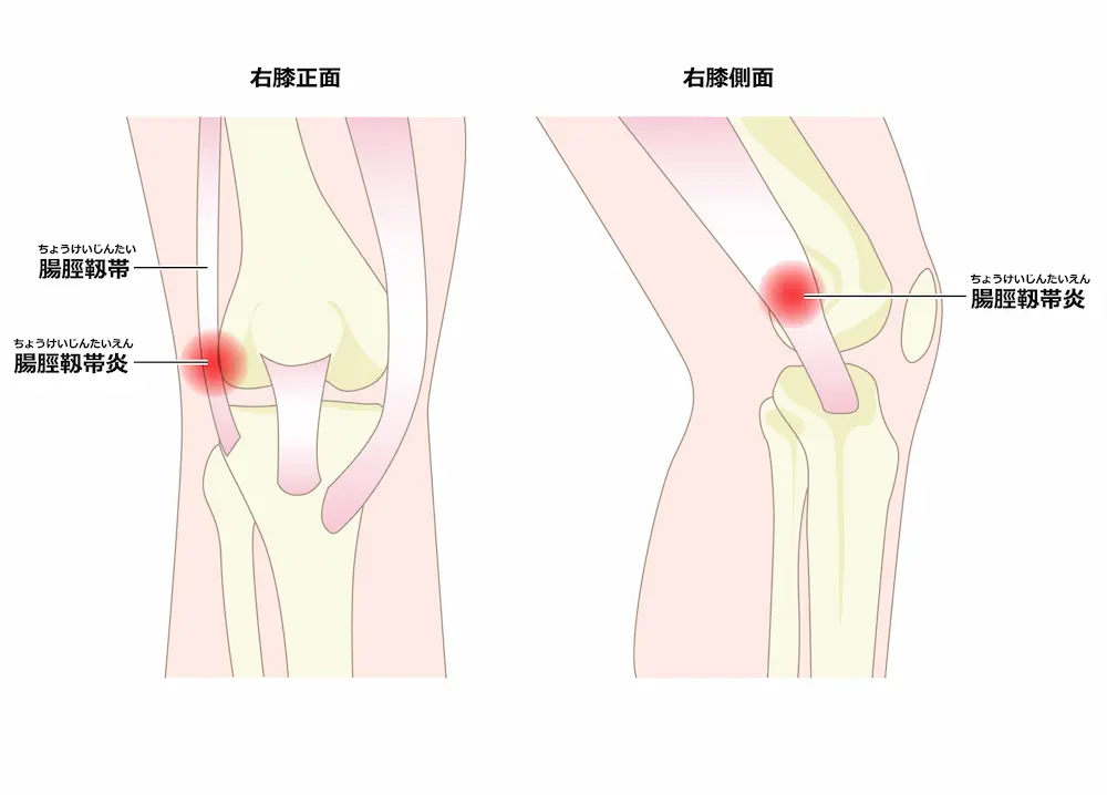 大阪市住吉区長崎はりきゅう接骨院の腸脛靭帯炎の画像