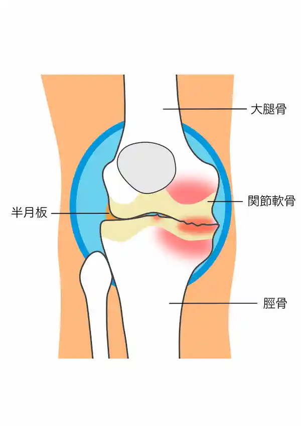 変形性膝関節症の画像